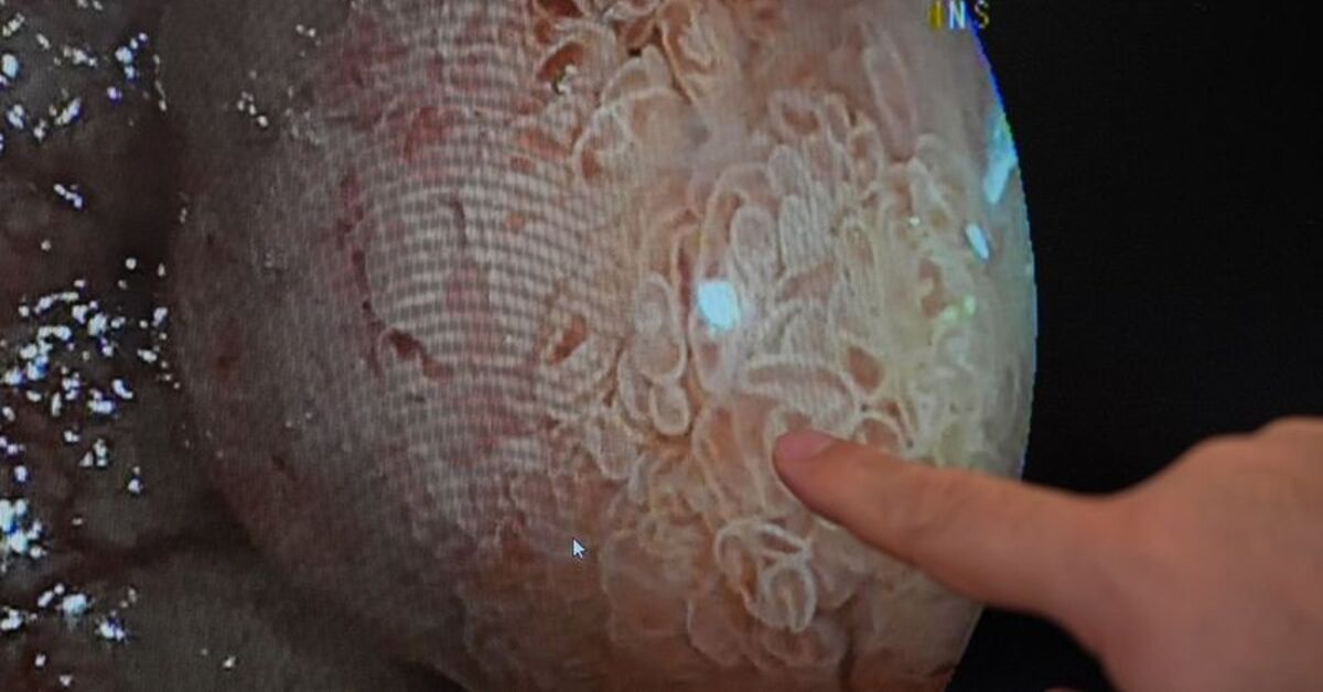 Diz ve kalça ağrısıyla gitti, bağırsak kanseri olduğunu öğrendi